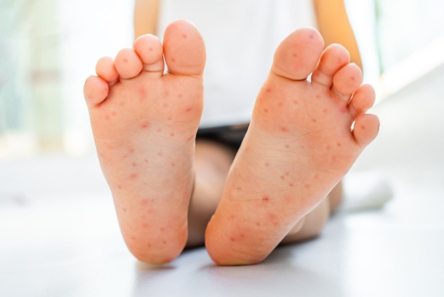 【疾病衛教】 腸病毒疫情升溫，小心大人傳染孩子， 小兒醫盤點預防6方法、8警訊